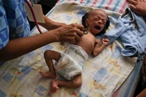 Hình ảnh khủng khiếp về tình hình suy dinh dưỡng của trẻ em Venezuela