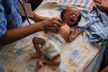 Hình ảnh khủng khiếp về tình hình suy dinh dưỡng của trẻ em Venezuela