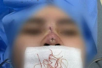 Hà Nội: Cô gái trẻ bị thủng mũi sau căng chỉ làm đẹp