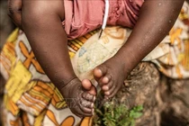 Việt Nam đã ghi nhận hơn 100 trường hợp mắc đậu mùa khỉ