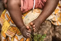 Việt Nam đã ghi nhận hơn 100 trường hợp mắc đậu mùa khỉ