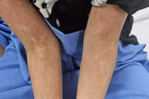 2 trẻ nhập viện gấp vì nhiễm xoắn khuẩn nguy hiểm