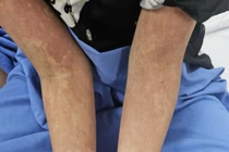 2 trẻ nhập viện gấp vì nhiễm xoắn khuẩn nguy hiểm