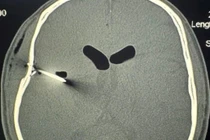 Người đàn ông bị đinh sắt đâm xuyên xương sọ