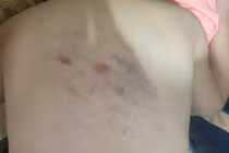 Thanh Hoá: Học sinh lớp 1 bị cô đánh vào lưng gây thâm tím