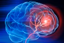 Người đàn ông liệt nửa người do chủ quan sau đột quỵ 