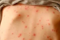 Một công ty ở Bến Tre có 83 ca mắc thủy đậu