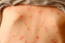 Một công ty ở Bến Tre có 83 ca mắc thủy đậu