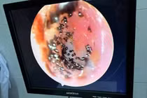 Nội soi gắp ổ ve rận trong tai bé gái 6 tuổi