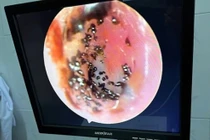 Nội soi gắp ổ ve rận trong tai bé gái 6 tuổi