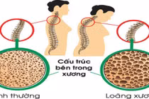 Những thói quen khi trẻ khiến chưa già đã loãng xương