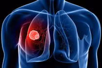 5 bệnh ung thư người Việt Nam mắc phải nhiều nhất hiện nay