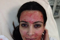 Sự thật sốc: Làm đẹp bằng máu nguy cơ phơi nhiễm HIV