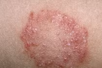 Điểm mặt bệnh ngoài da người Việt mắc nhiều nhất hè 2018