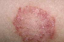 Điểm mặt bệnh ngoài da người Việt mắc nhiều nhất hè 2018