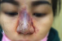 Liên tục cấp cứu biến chứng tiêm filler, bác sĩ nói gì?