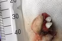 Phát hiện khối u quái dị mọc răng trong bụng bé gái 12 tuổi ở Quảng Ninh