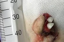 Phát hiện khối u quái dị mọc răng trong bụng bé gái 12 tuổi ở Quảng Ninh