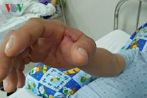 Báo động bệnh nhân bị rắn độc cắn tăng đột biến