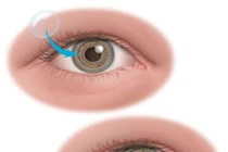 Từ "ngọn lửa Hải An, Vân Nhi": Những điều ít biết về cấy ghép giác mạc 