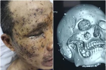 Kinh hoàng bệnh nhân ở Quảng Ninh bị cả trăm mảnh kim loại găm vào mặt