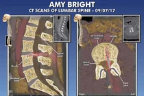 Bị liệt vì bác sĩ để quên kim tiêm trong cột sống suốt 14 năm 