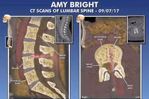 Bị liệt vì bác sĩ để quên kim tiêm trong cột sống suốt 14 năm 