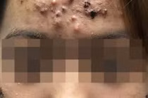 Chữa mụn ở phòng khám tư, mặt cô gái mưng mủ đau nhức