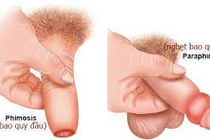 Suýt hỏng “của quý” sau khi cắt bao quy đầu ở phòng khám tư