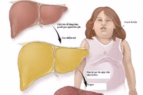 Vì sao dân văn phòng dễ mắc gan nhiễm mỡ?