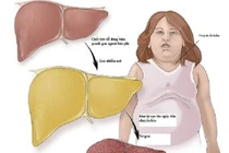 Vì sao dân văn phòng dễ mắc gan nhiễm mỡ?