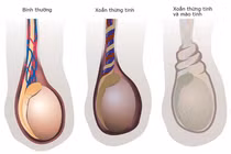 Bị hoại tử, bé 2 ngày tuổi phải cắt bỏ tinh hoàn 