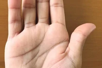 Đến nha sĩ kiểm tra đơn giản, tá hỏa phát hiện nhiễm trùng có thể tử vong 