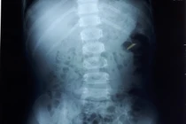 Bắc Giang: Mẹ “tá hỏa” khi thận con trai 8 tuổi đầy sỏi