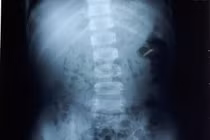 Bắc Giang: Mẹ “tá hỏa” khi thận con trai 8 tuổi đầy sỏi