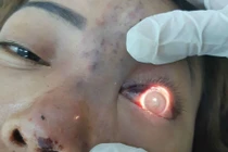 Tiêm filler bị mù mắt: Chỉ xử phạt hành chính spa không phép