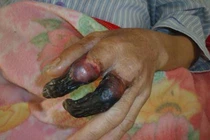 Bị vết xước nhỏ, 8 ngày sau người đàn ông ở Thái Bình cận kề cái chết 