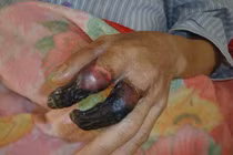 Bị vết xước nhỏ, 8 ngày sau người đàn ông ở Thái Bình cận kề cái chết 