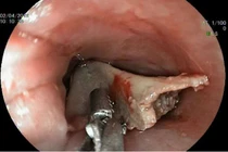 Hy hữu những ca hóc dị vật nguy hiểm ở Việt Nam