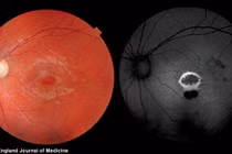 Cậu bé 9 tuổi mù mắt vì đèn laser đồ chơi