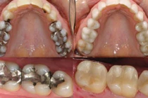 Video: Mẹo thần kì giúp răng sâu mọc trở lại