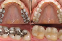 Video: Mẹo thần kì giúp răng sâu mọc trở lại