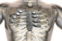 Bệnh nhân ung thư được ghép xương bằng máy in 3D