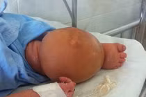 Cứu sống em bé có cơ thể phù to bất thường 