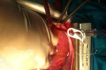 Kinh khủng bệnh nhân bị kim đâm thấu tim