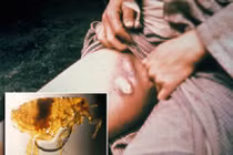 4 loài côn trùng hút máu nguy hiểm cho con người