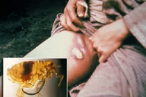 4 loài côn trùng hút máu nguy hiểm cho con người