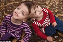 Điểm lại những ca sơ sinh dính liền nổi tiếng