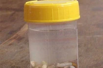 Cuộc chiến kỳ diệu của bé bị 50 con dòi ăn đứt tai