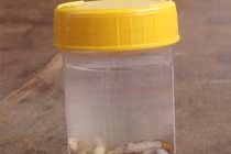 Cuộc chiến kỳ diệu của bé bị 50 con dòi ăn đứt tai